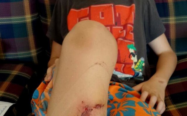 Leo Lotz met die ernstige wond wat hy aan sy been opgedoen het tydens sy heldhaftige optrede